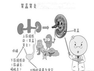 医生解析：肾盂肾炎的症状有哪些