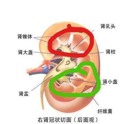 肾结石的症状