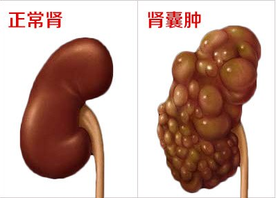 男性腰痛腰酸、腰胀小心是肾囊肿?肾囊肿的症状是什么?